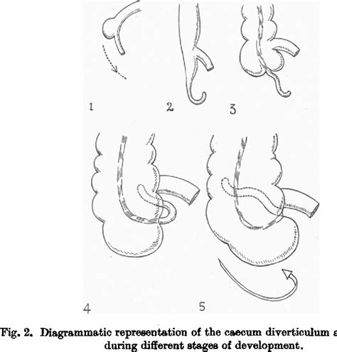 Figure 2 From The Position Of The Vermiform Appendix As Ascertained By
