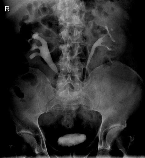 Retroperitoneal Fibrosis On Intravenous Pyelogram Radiology Case