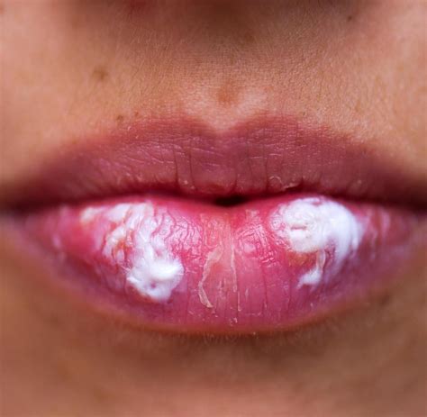 Herpes Simplex An Lippen Und Genitalien Ist Ansteckend
