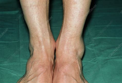 View Of Swollen Left Ankle Due To Sprain Stock Image M3300422