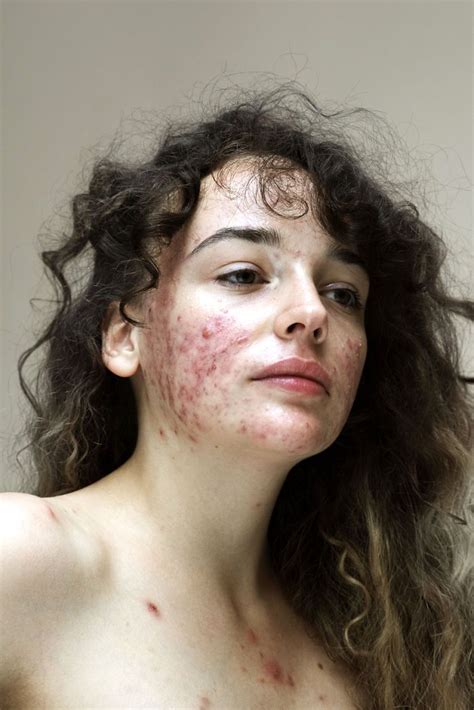 Women Skin Problems Epidermis Project Sophie Harris Taylor Facetune