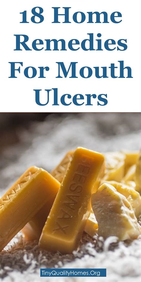 18 Effective Home Remedies For Mouth Ulcers