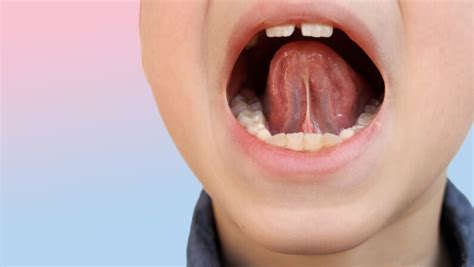 What Is Frenectomy All The Things You Need To Know Brownstone Dental