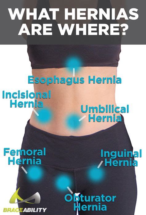 20 Best Hernia Types And Treatment Abdominal Umbilical And Inguinal
