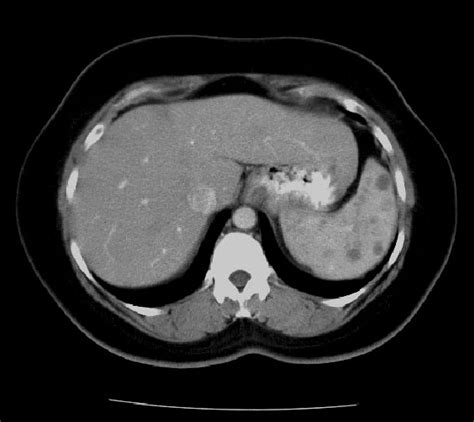 Ct Abdomen Showing An Enlarged Spleen With Multiple Hypodense Lesions