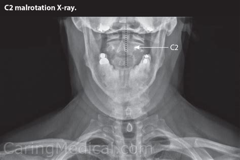 Cervical Disc Disease And Difficulty Swallowing Cervicogenic