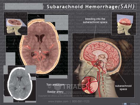Subarachnoid Hemorrhage Sah Trial Exhibits Inc