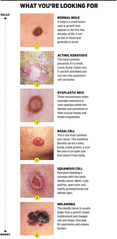 Skin Cancers And Your Skin Dr Seymour Weaver Dermatology Blog