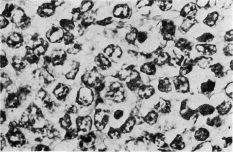 Lymph Node Showing Predominance Of Immature Lymphoplasmacytoid Cells X