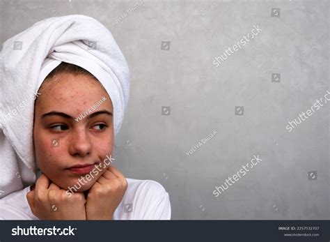 Teenage Girl Acne On Her Face Stock Photo 2257532707 Shutterstock