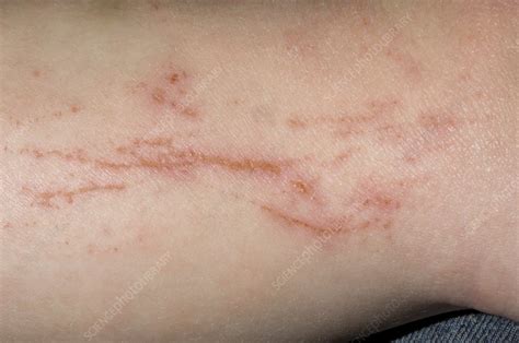 Atopic Eczema With Scratch Marks Stock Image C002 9569 Science Photo Library