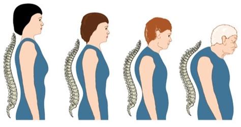 Hormone Therapy May Protect Against Curvature Of The Spine Wimbledon