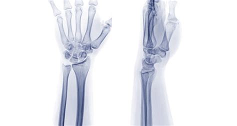 X Ray Wrist Lateral View