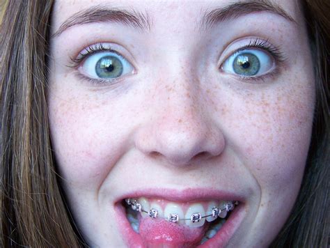Girls With Braces On Twitter Cute Braces Braces Girls Hot Sex Picture
