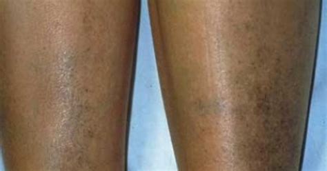 Hyperpigmentation On Leg Area Hyperpigmentation Melasma Pinterest