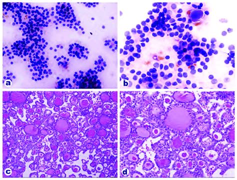 Cytology And Histomorphology Suggestive Of Follicular Carcinoma
