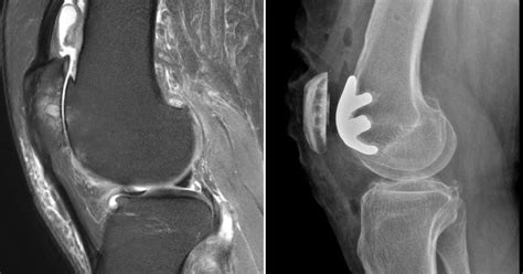 advancements in orthopaedic for hip and knee replacement surgeries