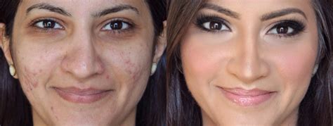 Acne Scars Removal In Abu Dhabi Dr Chris Reuter
