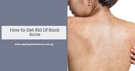 How To Get Rid Of Back Acne Apple Queen Beauty