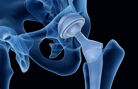 Exercises To Avoid After A Total Hip Replacement Best Physical