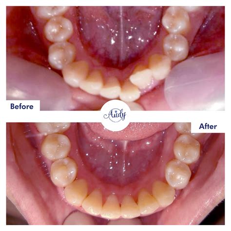 Behel Gigi | Audy Dental