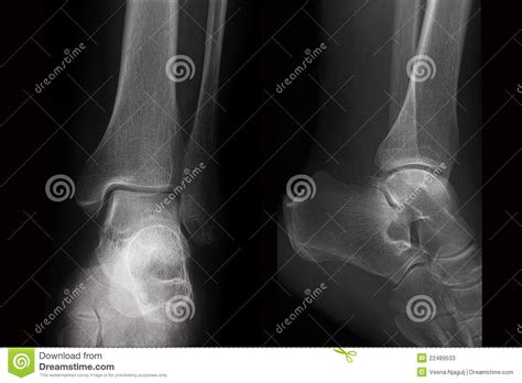 An emergency room visit typically is covered by health insurance. Radiography Of Ankle In Two Projections Stock Photos - Image: 22489533