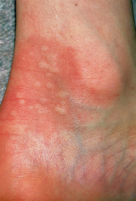 Urticaria Rash Hives On Ankle Due To Nettles Photograph By Dr P Marazzi Science Photo Library