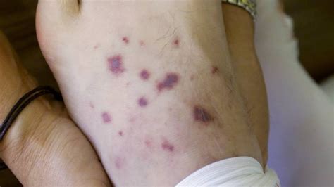 Several Strains Of Meningococcal Disease Says Moh Fbc News