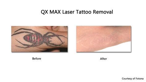 Laser Tattoo Removal Nyc And Garden City Prasad Cosmetic Surgery