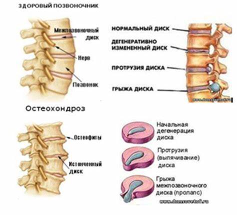 Остеохондроз | lemur59.ru Картинка - Остеохондроз | lemur59.ru