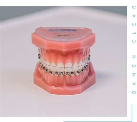 Braces Inspire Orthodontics