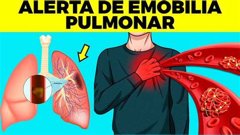 Embolia Pulmonar Causas Sintomas E Tratamento Youtube Porn Sex Picture