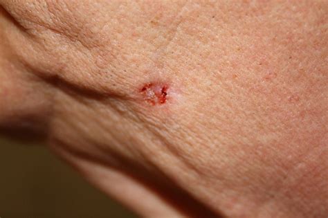 Basal Cell Carcinoma Causes And Homeopathic Treatment