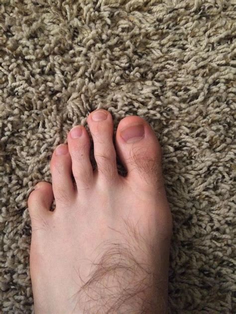 My Second Toe Is Longer Than My Big Toe Which Is Known As Mortons Toe