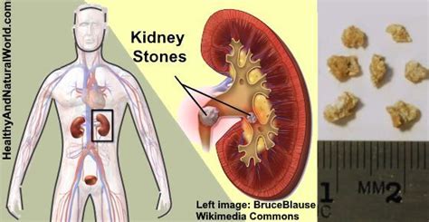 Kidney Stones Early Signs And Symptoms You Shouldnt Ignore Nestia