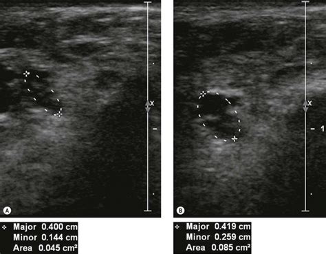 Imaging Of The Elbow Clinical Gate