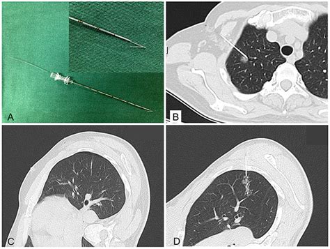 Ct Guided Hookwire Localization Before Video Assisted Thoracoscopic