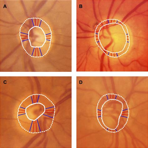 The Accuracy Of The Inferiorsuperiornasaltemporal Neuroretinal Rim