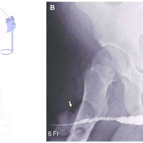 Technique For Retrograde Urethrography A Illustration Showing
