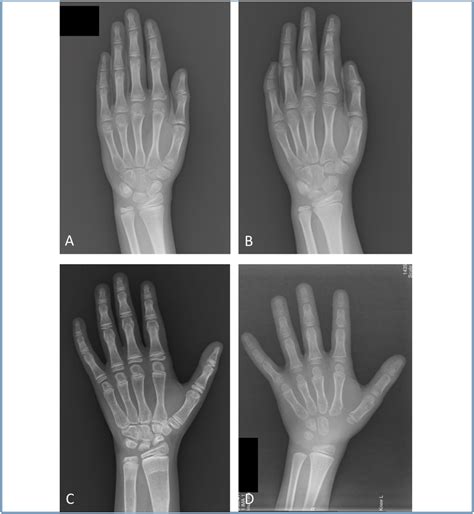 Examples Of Left Hand Bone Age Ba Radiographs From Four Different
