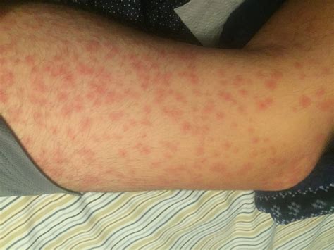 Allergic Reaction To Amoxicillin Rash Hives Oh My Home Remedies