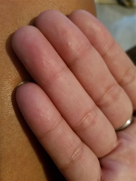 Mild Dyshidrotic Eczema Palms