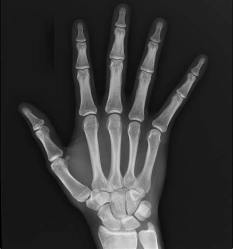 Normal Hand X Ray Hand X Ray Causes Symptoms Treatment Hand X Ray