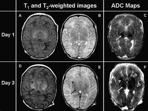 Advanced Neuroimaging Techniques For The Term Newborn With