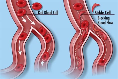 Sickle Cell Anemia And Malaria Simplebiol