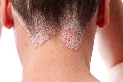 Excimer Laser Therapy For Hairline Psoriasis A Useful Addition To The