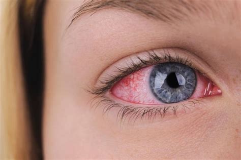 What Is Eye Herpes Causes And Treatment The Eye News