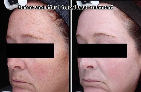 Fraxel Laser Kansas City What To Expect Kansas City Dermatologists