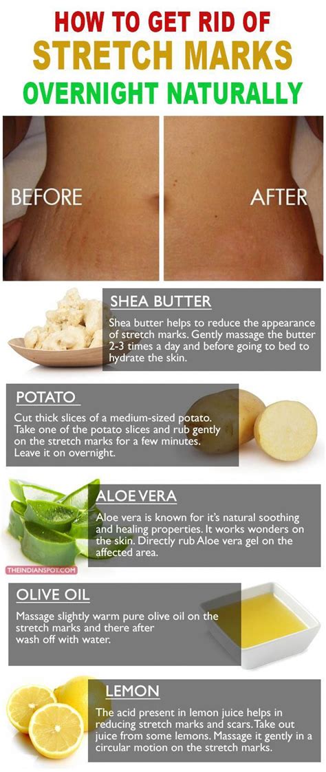 How To Natural Stretch Marks Stretch Mark Remedies Stretch Mark Removal