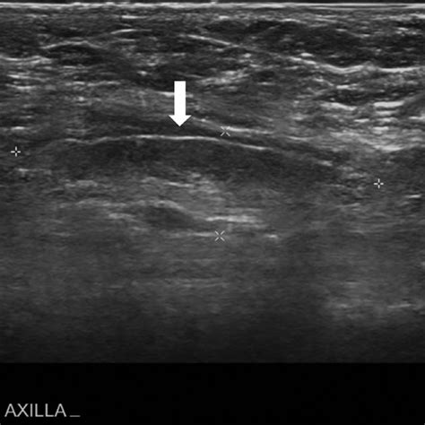 A B Right Breast Ultrasound Ill Defined Hypoechoic Mass With